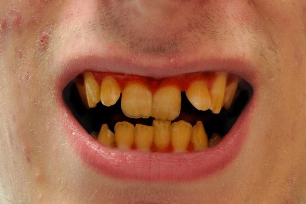 Tooth Decay